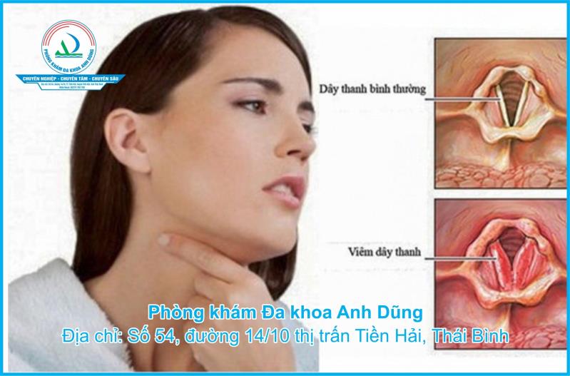 Viêm thanh quản cấp: Triệu chứng, nguyên nhân và cách điều trị