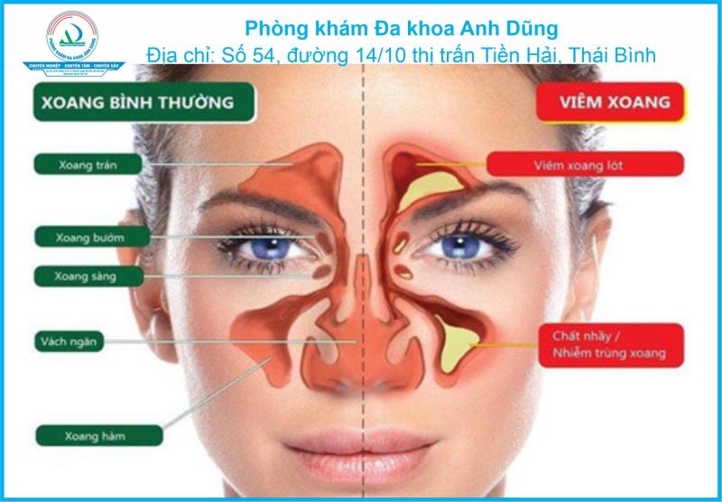 Viêm xoang: Triệu chứng, nguyên nhân và cách phòng ngừa