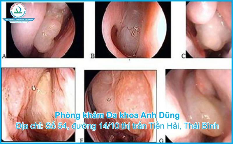 Polyp mũi: Các dấu hiệu nhận biết và phương pháp điều trị