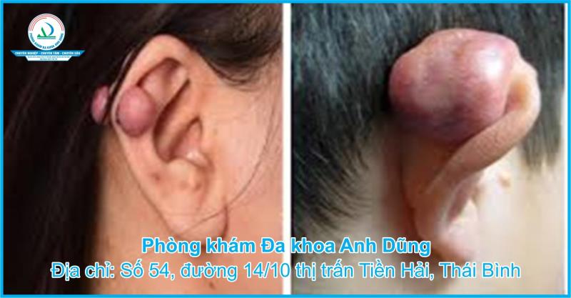 Sẹo lồi vành tai: Nguyên nhân và cách điều trị hiệu quả