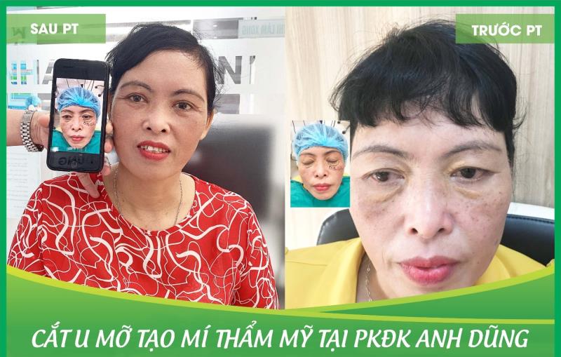 Bệnh U vàng- U mỡ vàng- Ban vàng mi mắt: bệnh mi mắt có gợi ý tình trạng tăng mỡ máu?