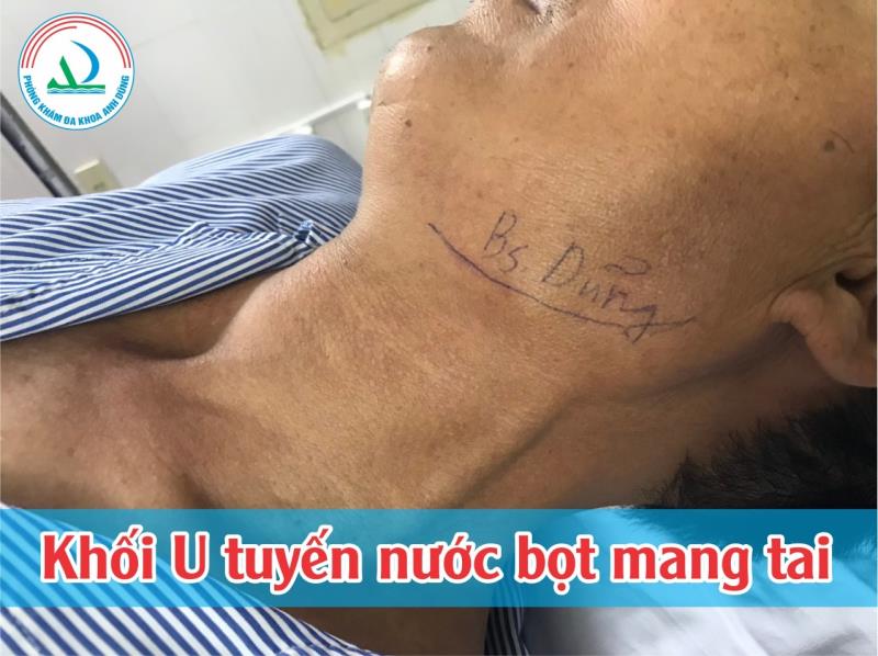 Phẫu thuật cắt U tuyến nước bọt dưới hàm tại khoa Răng - Hàm - Mặt