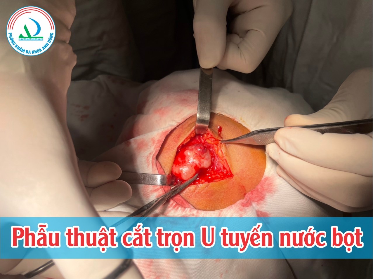 Phẫu thuật cắt U tuyến nước bọt dưới hàm tại khoa Răng - Hàm - Mặt ...